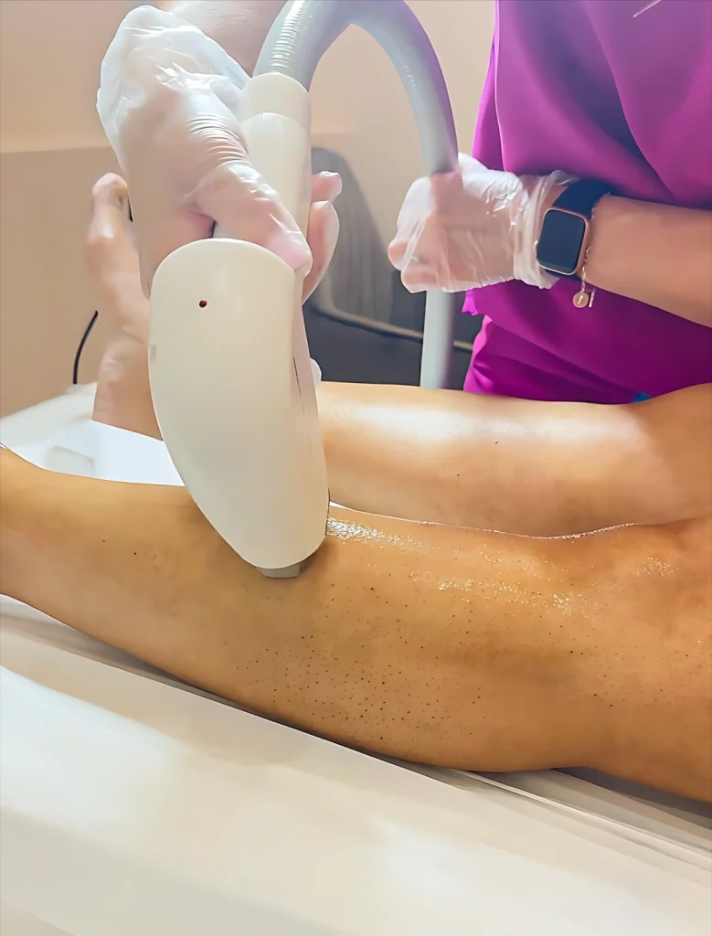 Laser Hair Removal