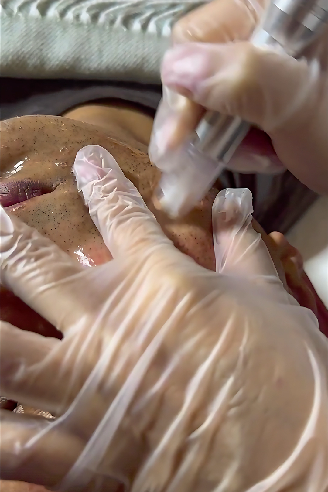 Microneedling Treatment