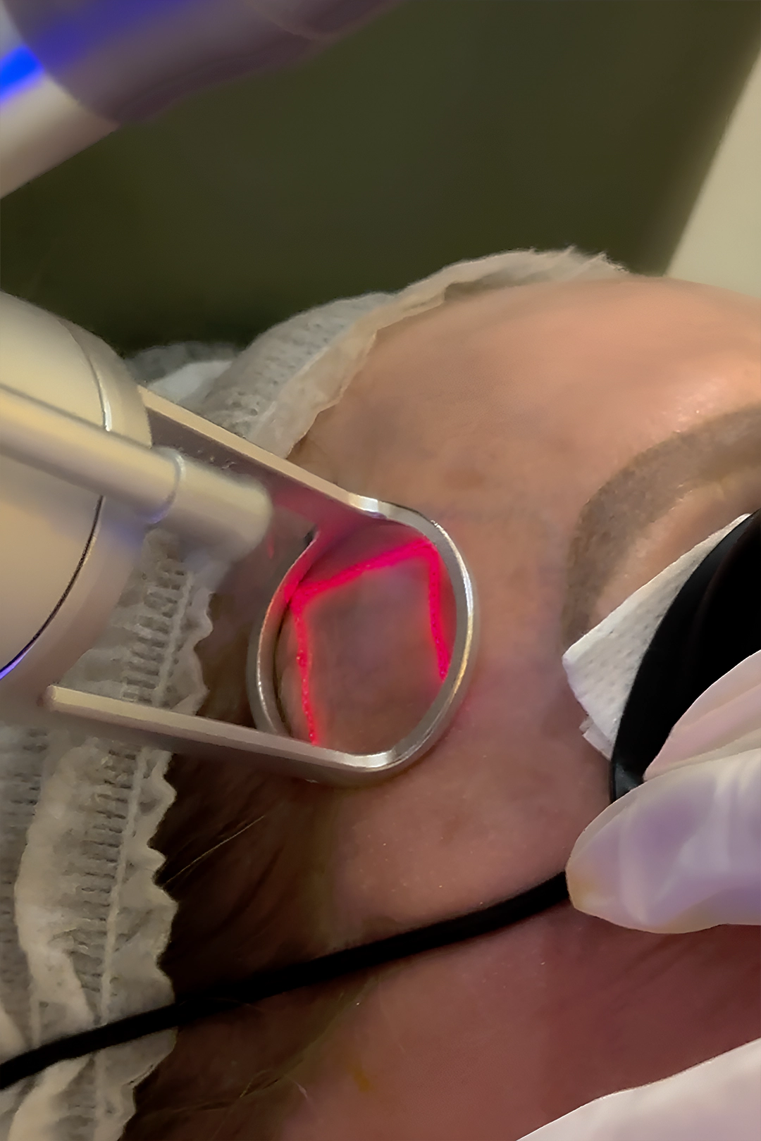 co2 laser treatment