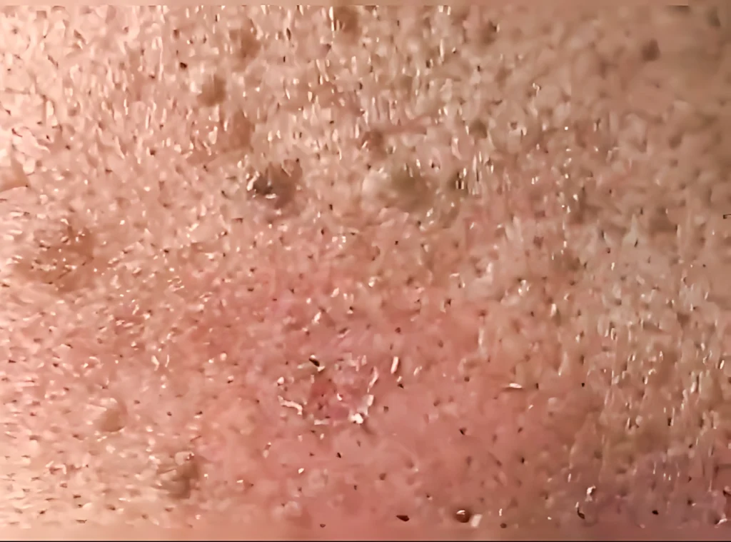 Skin Tag & Mole Removal
