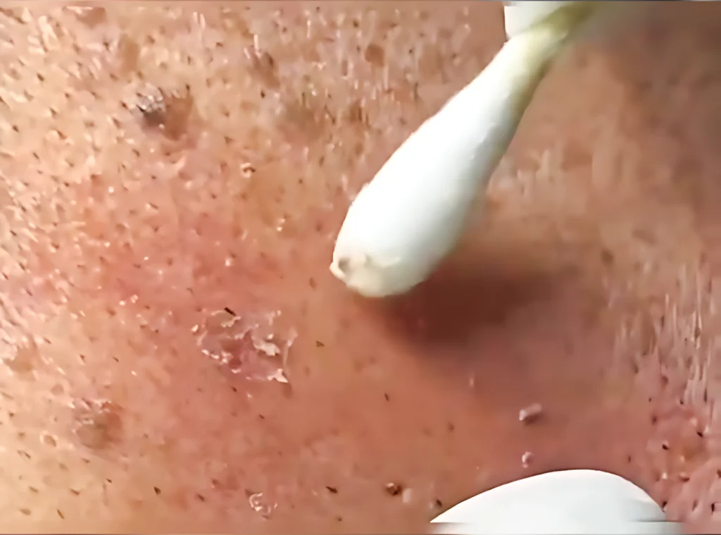 Skin Tag & Mole Removal