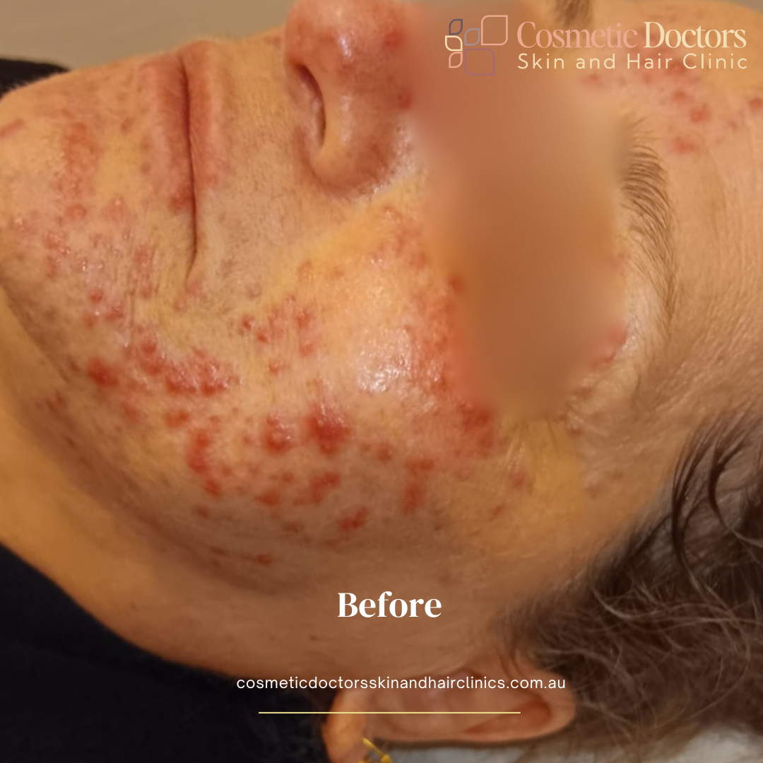 Advanced Skin Treatments