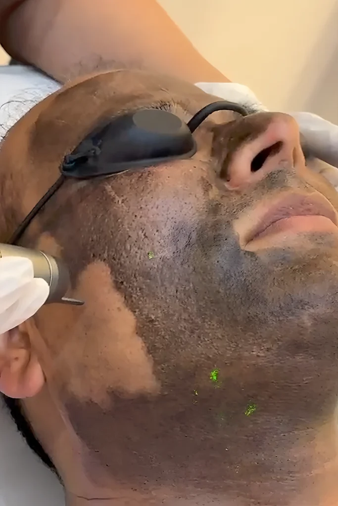 PICO Laser Treatments