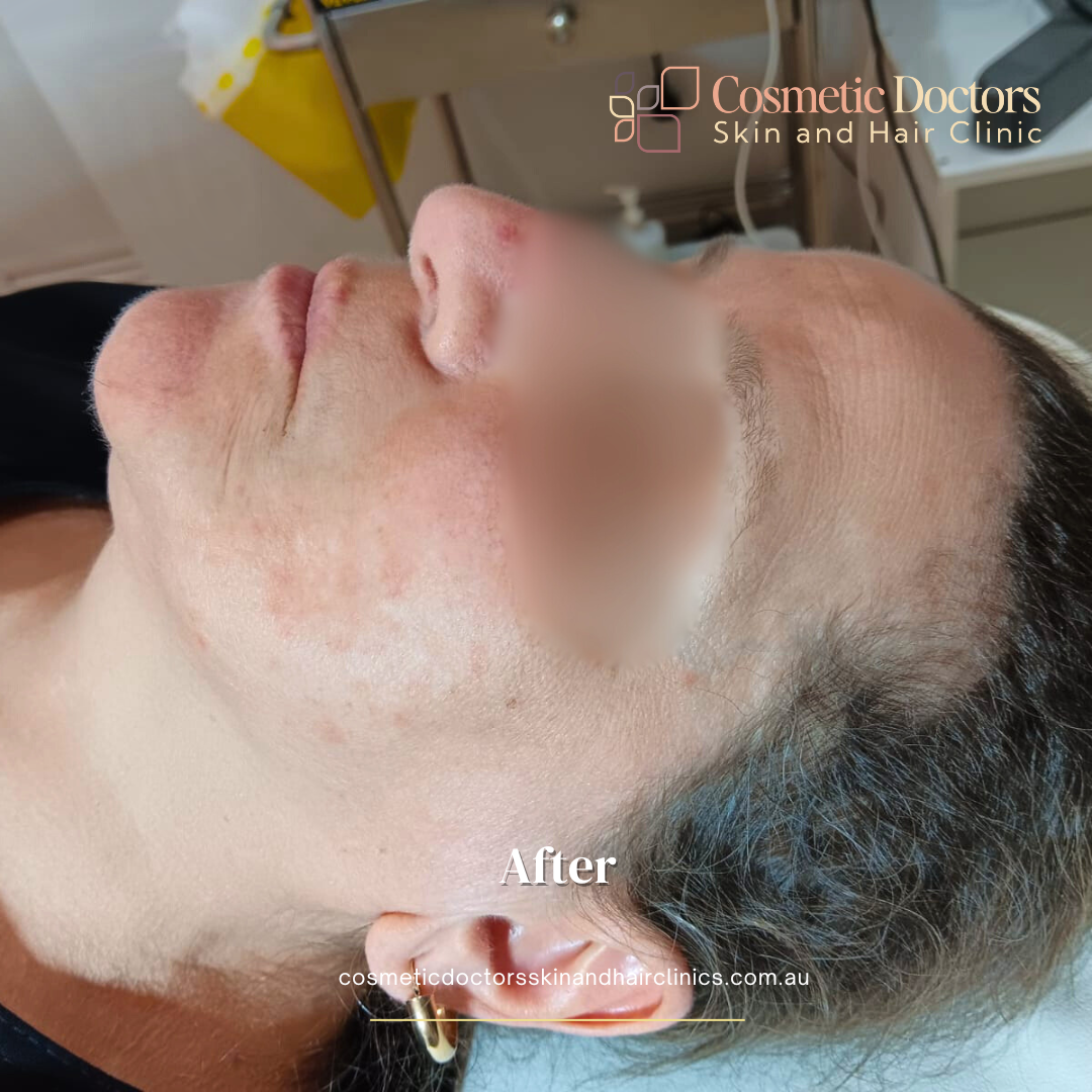 Advanced Skin Treatments