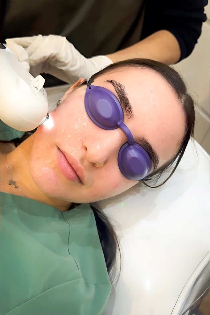 IPL Treatments