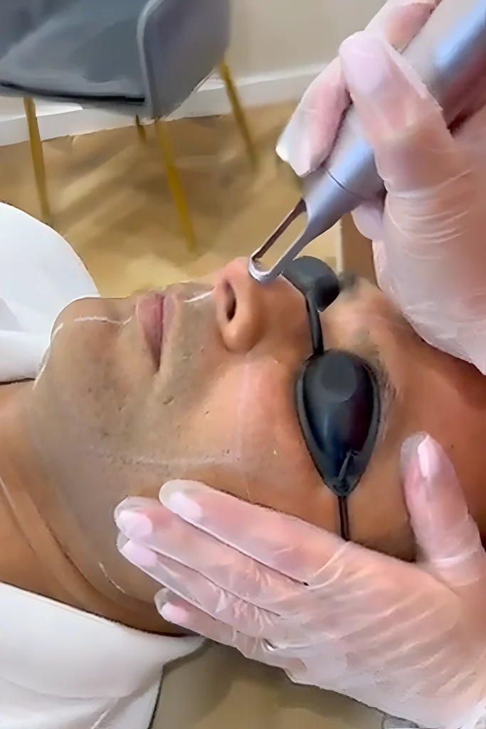 PICO Laser Treatments