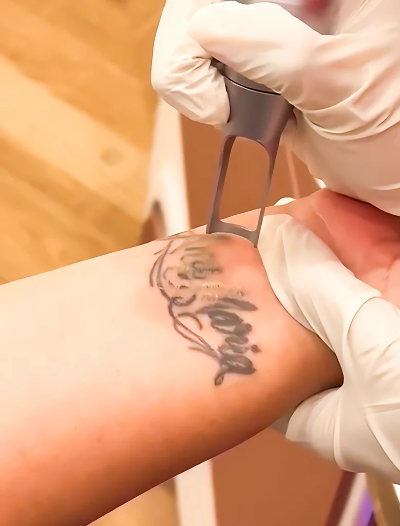 Tattoo Removal