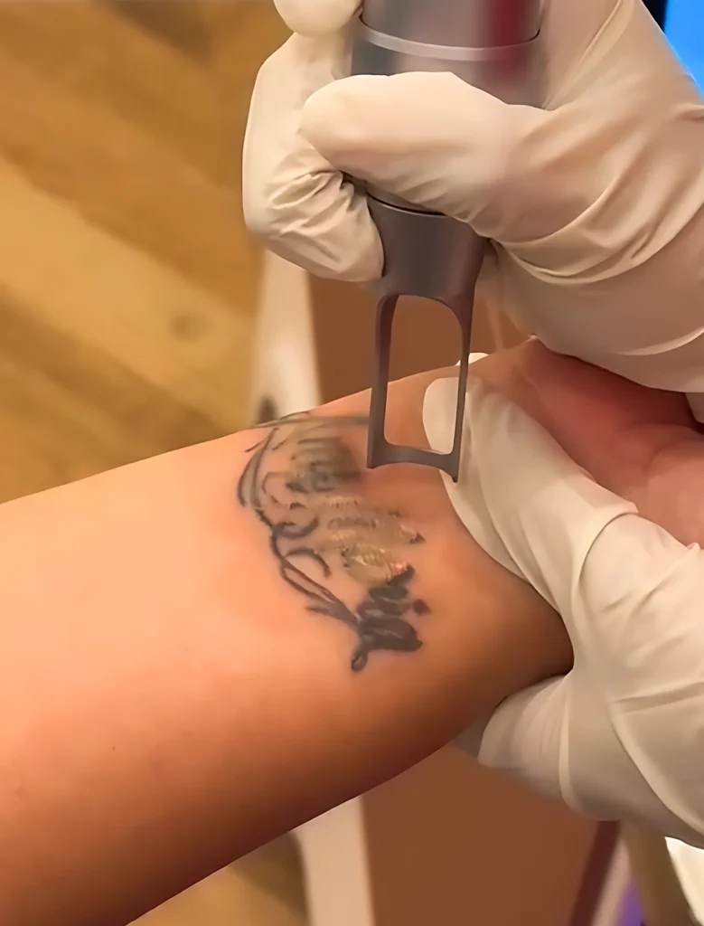 Tattoo Removal
