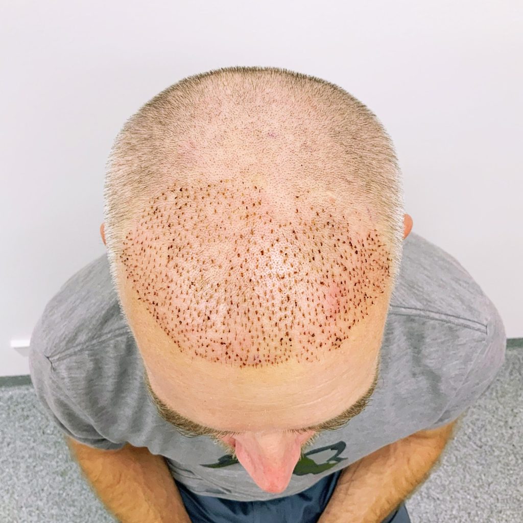Hair Transplant