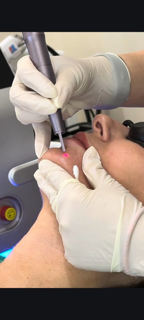 Skin Tag & Mole Removal