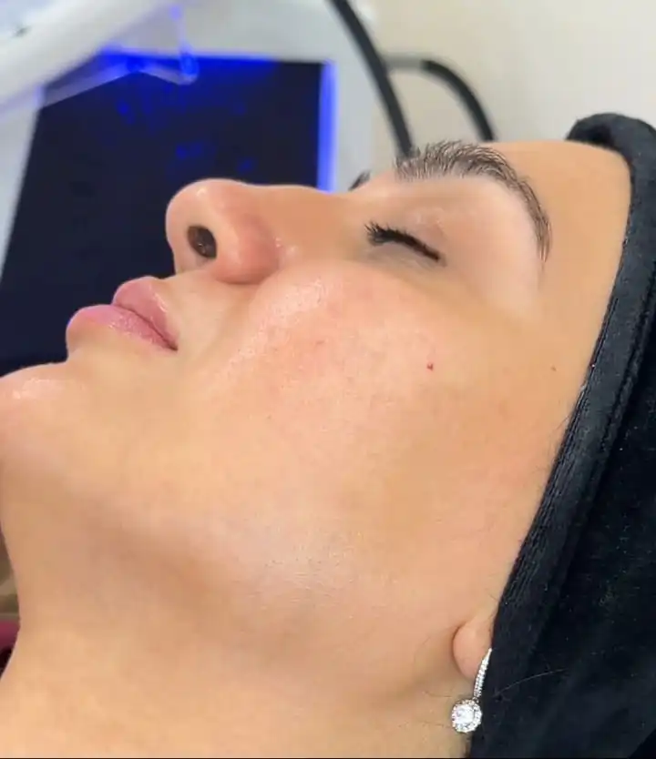 Needle-Free Mesotherapy