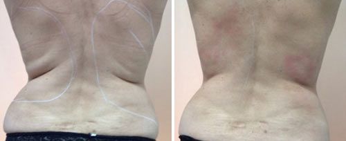 TightSculpting Body Contouring