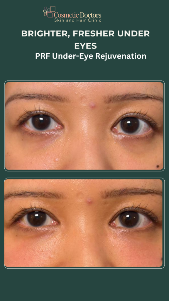 Under-Eye PRF Full Face PRF