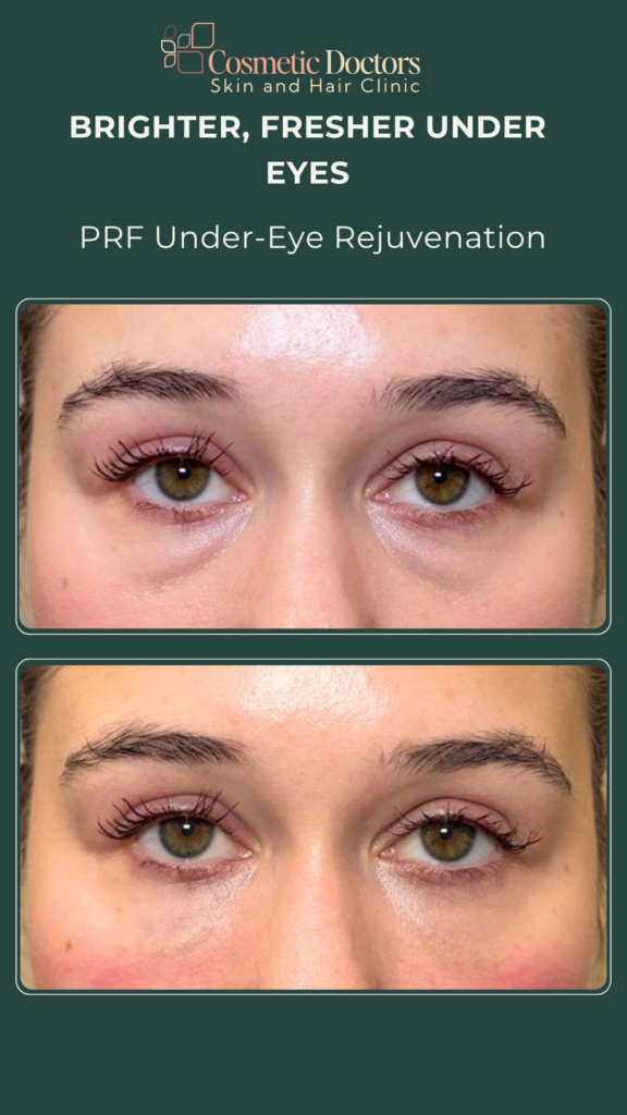 Under Eye PRF