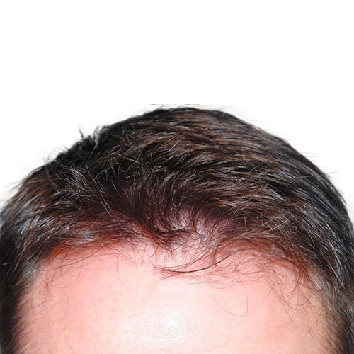 ARTAS Hair after (2)