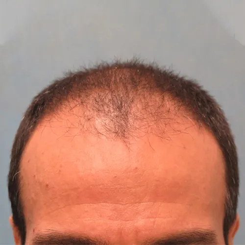 ARTAS Treatment ARTAS Treatment