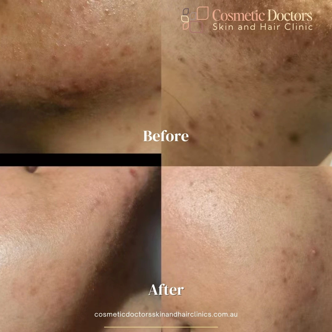 Acne face testimoial
