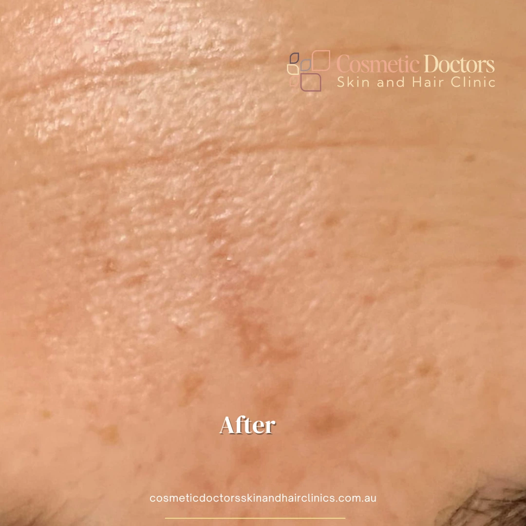 After-treatment