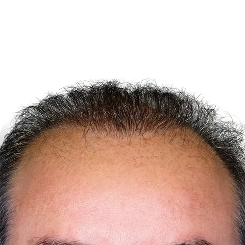 Artas hair after