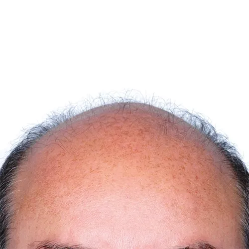 Artas hair before Artas hair before