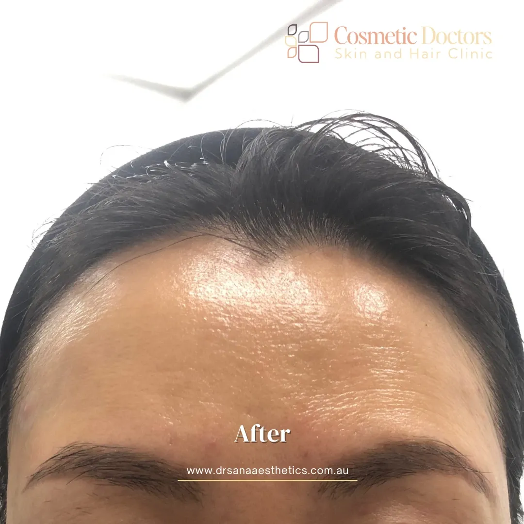 CO2 Laser treatment after