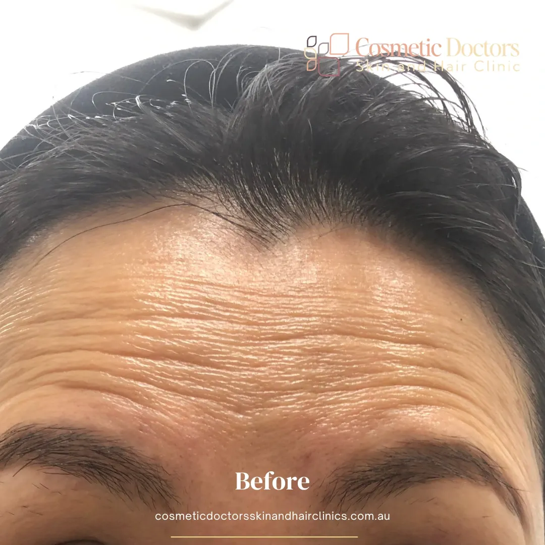 CO2 Laser treatment before