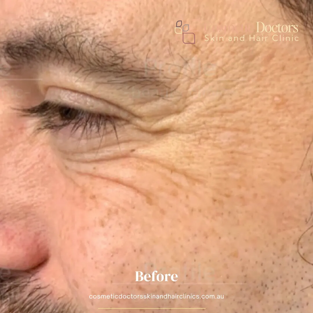 CO2 treatment before