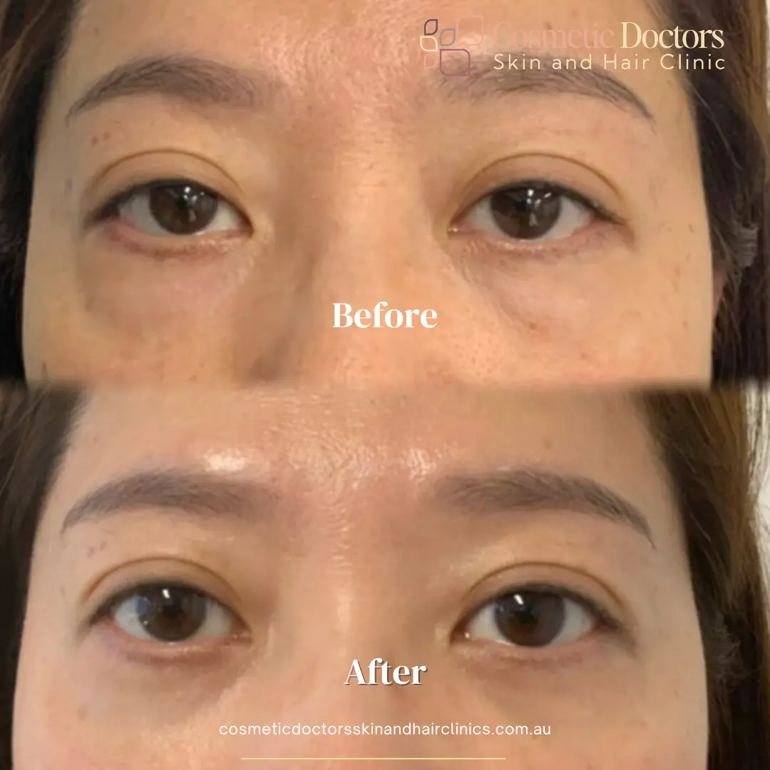 Eyebag treatment lady before-after
