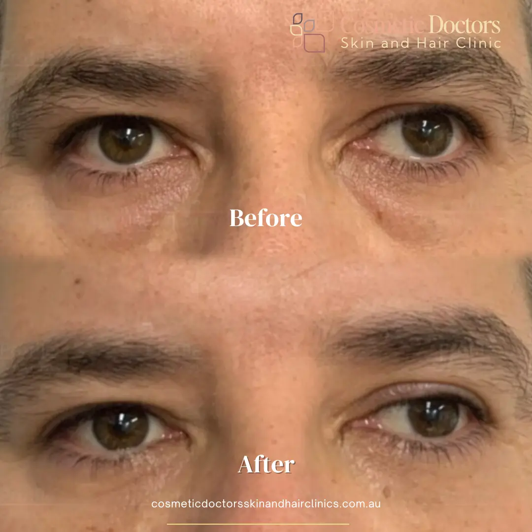 Eyebag treatment men before-after