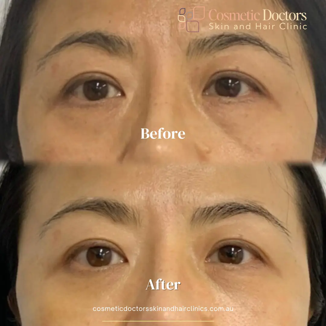Eyebag treatment old lady before-after