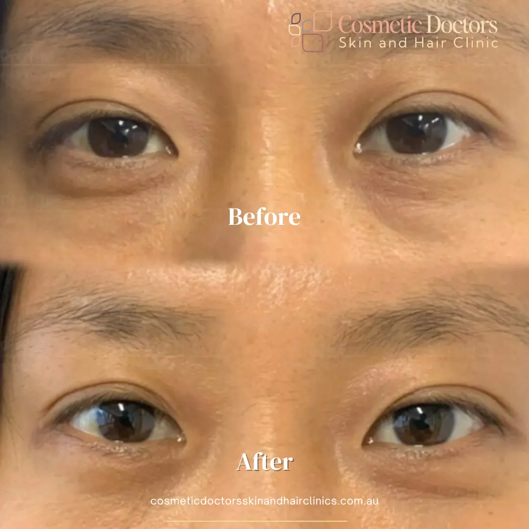 Eyebag treatment women before-after