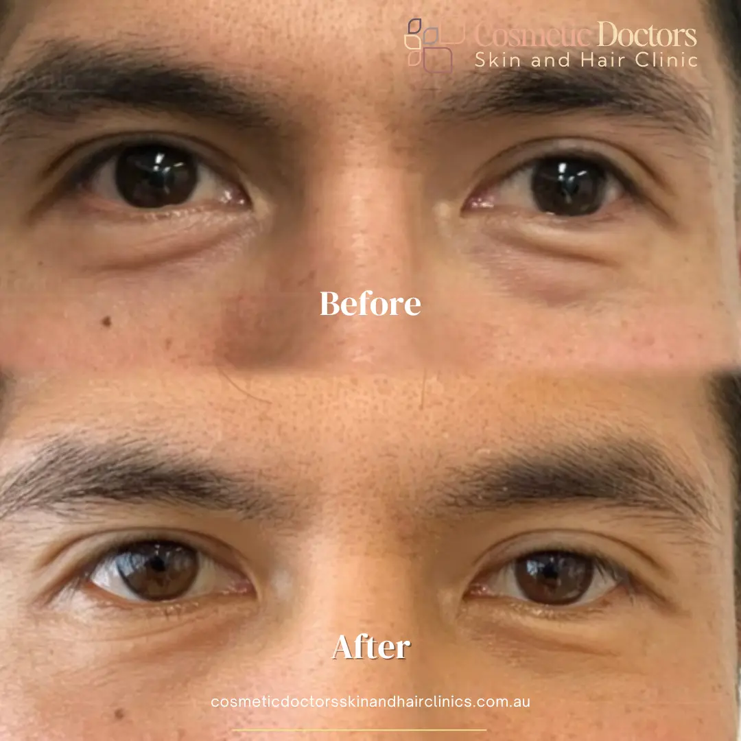 Eyebag treatment young before-after