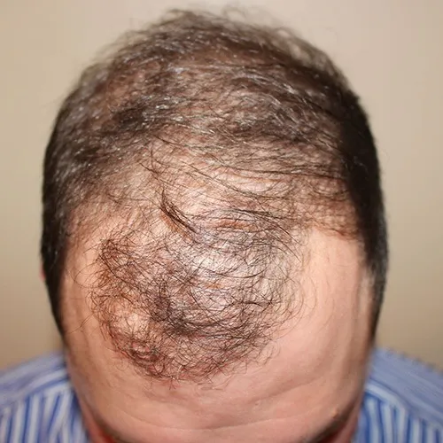Hair Restoration (2)