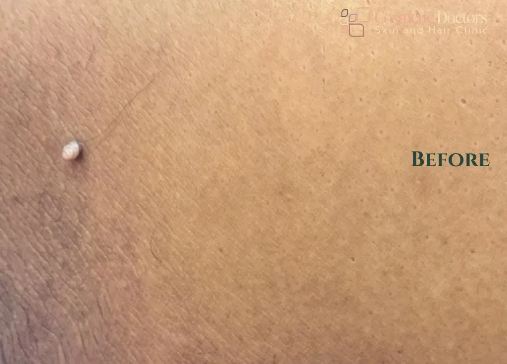Laser & Body Contouring Before