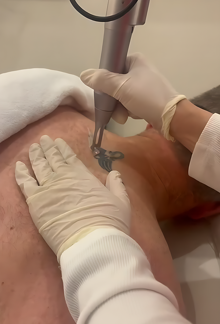 Laser Treatment
