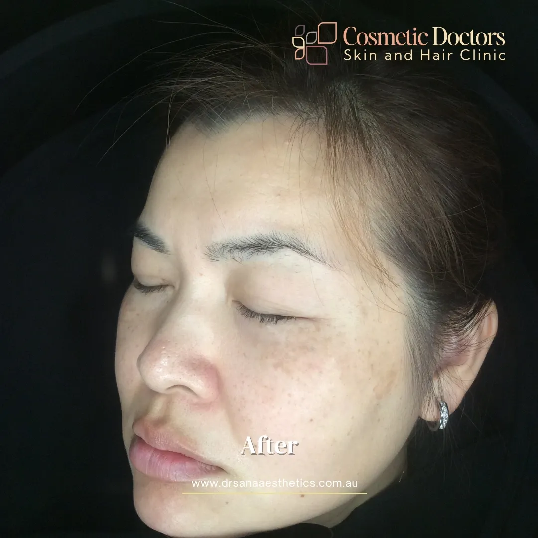 acne treatment after