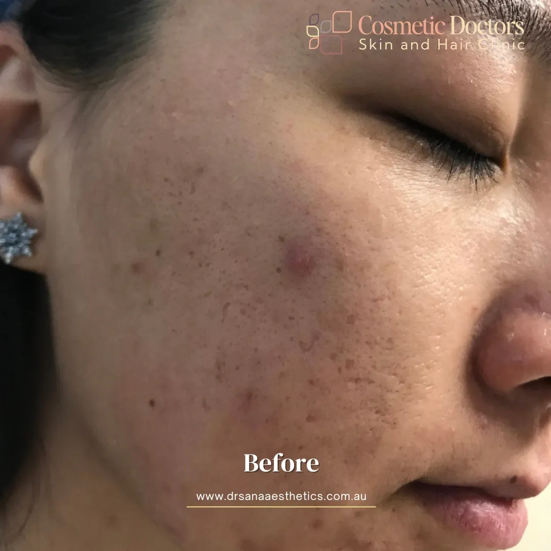 acne treatment before (2)