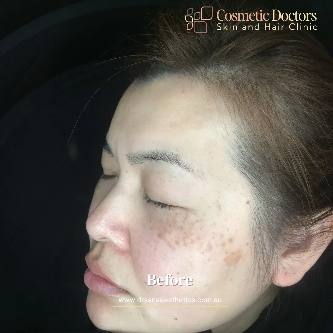acne treatment before