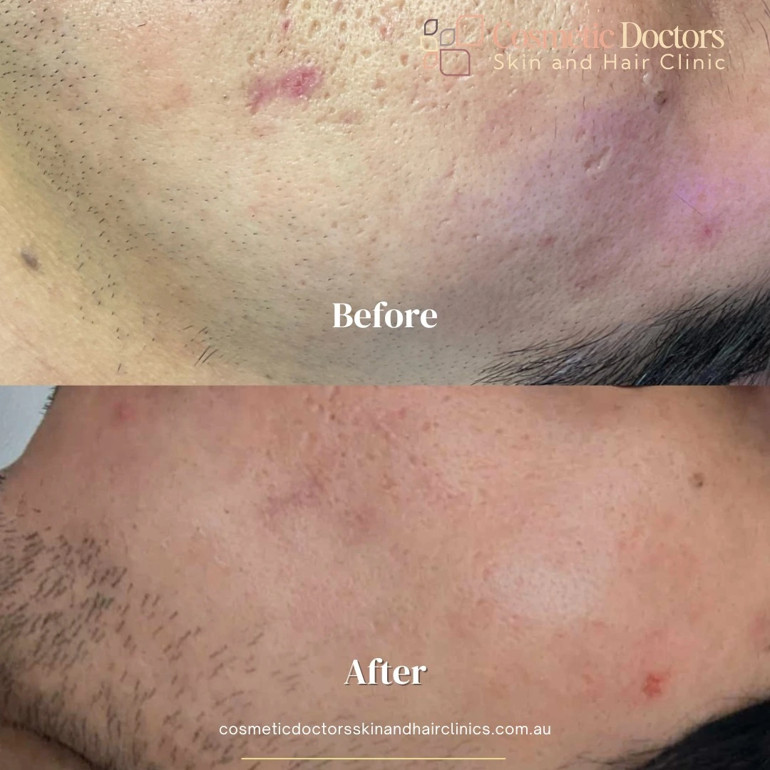 acne treatment before after