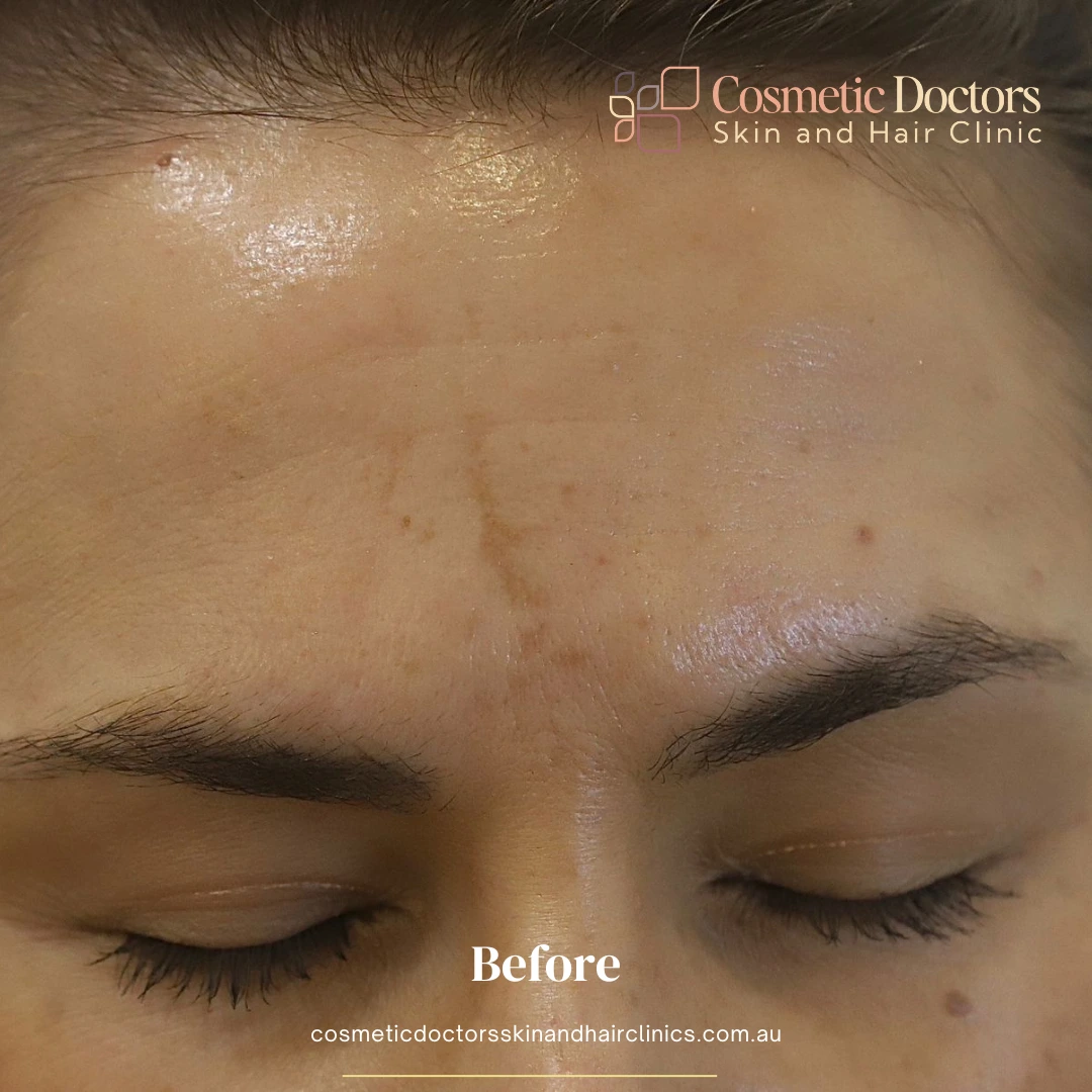 before-treatment