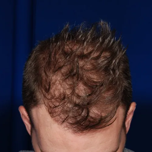 hair restoration