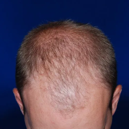 hair_restoration