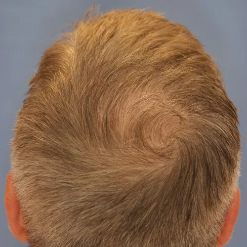 hair_restoration_a1