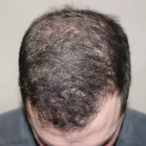 hair_restoration_a3