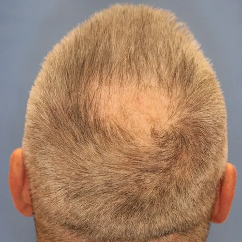hair_restoration_b1