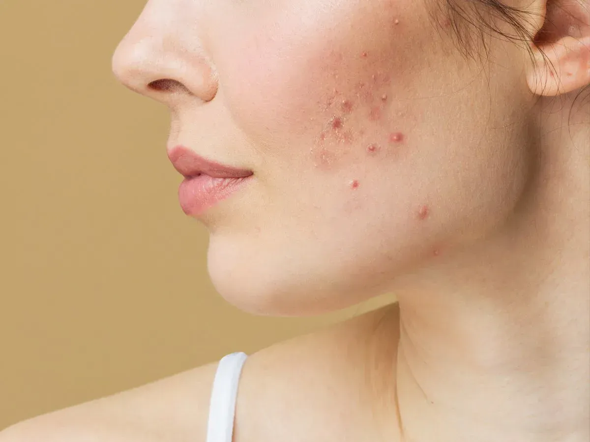 imgi_94_acne