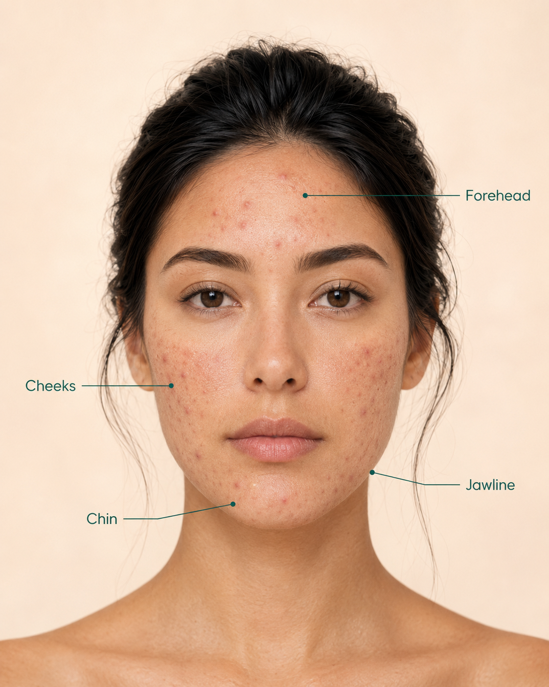 Front-facing portrait of a woman with visible acne on the forehead, cheeks, chin, and jawline, with labeled callouts identifying each area.