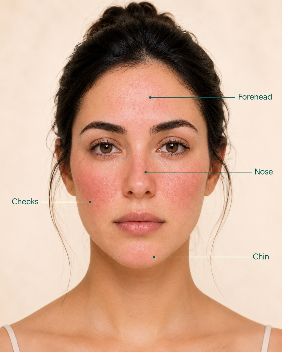 Front-facing portrait of a woman with rosacea-related redness across the forehead, cheeks, nose, and chin, with labeled callouts identifying each area.