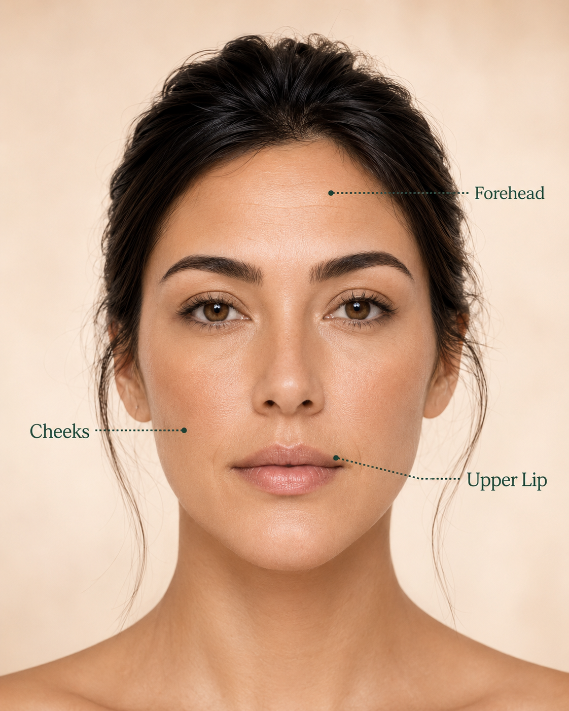 Woman’s face with marked treatment areas on the forehead, cheeks and upper lip for wrinkle assessment.