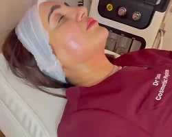 chemical peels